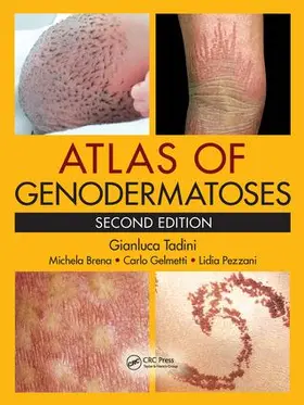 Tadini / Brena / Gelmetti |  Atlas of Genodermatoses | Buch |  Sack Fachmedien