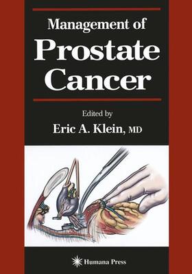 Klein |  Management of Prostate Cancer | Buch |  Sack Fachmedien