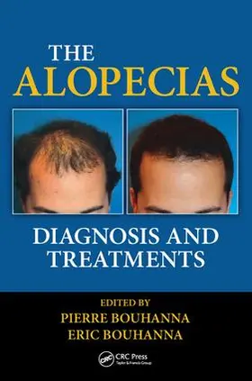 Bouhanna |  The Alopecias | Buch |  Sack Fachmedien