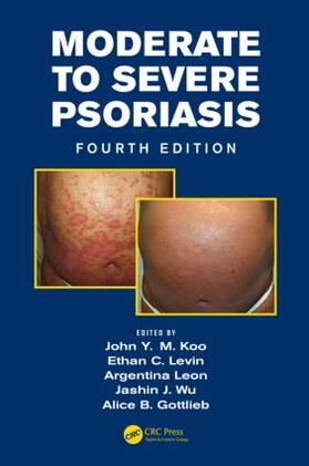 Koo / Leon / Wu |  Moderate to Severe Psoriasis | Buch |  Sack Fachmedien