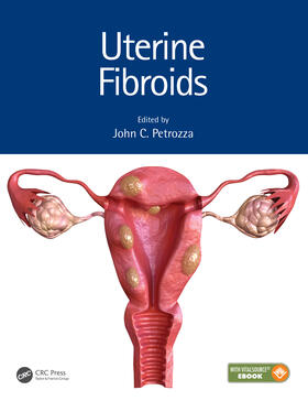 Petrozza |  Uterine Fibroids | Buch |  Sack Fachmedien