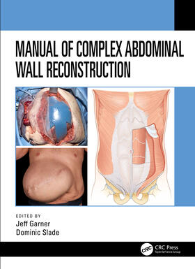 Slade / Garner |  Manual of Complex Abdominal Wall Reconstruction | Buch |  Sack Fachmedien