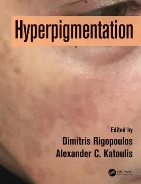 Rigopoulos / Katoulis |  Hyperpigmentation | Buch |  Sack Fachmedien