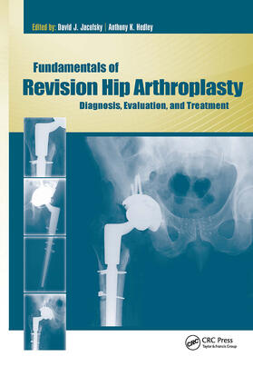 Jacofsky / Hedley |  Fundamentals of Revision Hip Arthroplasty | Buch |  Sack Fachmedien