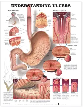  Understanding Ulcers Anatomical Chart | Sonstiges |  Sack Fachmedien