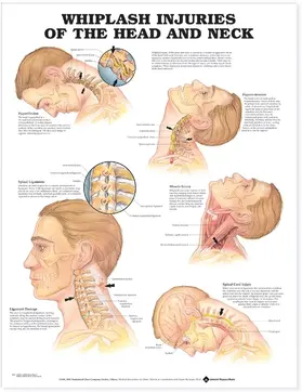  Whiplash Injuries of the Head and Neck Anatomical Chart | Sonstiges |  Sack Fachmedien