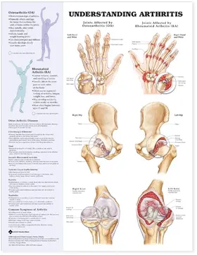  Understanding Arthritis Anatomical Chart | Sonstiges |  Sack Fachmedien