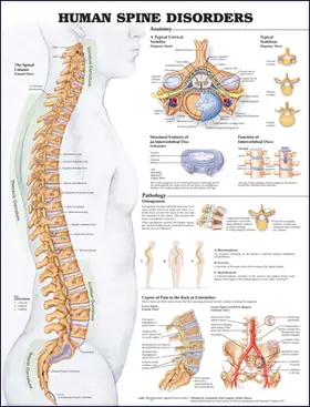  Human Spine Disorders Anatomical Chart | Sonstiges |  Sack Fachmedien