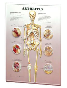  Arthritis: 3D Lenticular Chart | Sonstiges |  Sack Fachmedien