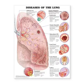  Diseases of the Lung Anatomical Chart | Sonstiges |  Sack Fachmedien