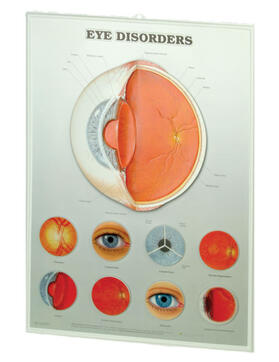  Eye Disorders: 3D Lenticular Chart | Sonstiges |  Sack Fachmedien