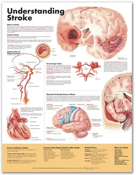  Understanding Stroke Anatomical Chart | Sonstiges |  Sack Fachmedien