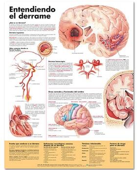  Understanding Stroke Anatomical Chart in Spanish (Entendiendo qué es un derrame) | Sonstiges |  Sack Fachmedien