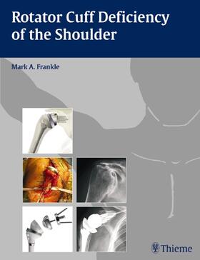 Frankle |  Rotator Cuff Deficiency of the Shoulder | Buch |  Sack Fachmedien