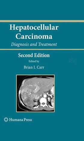 Carr |  Hepatocellular Carcinoma | Buch |  Sack Fachmedien