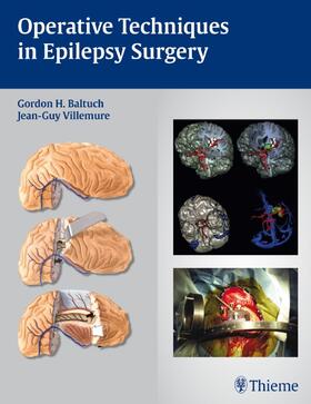 Villemure |  Operative Techniques in Epilepsy Surgery | Buch |  Sack Fachmedien