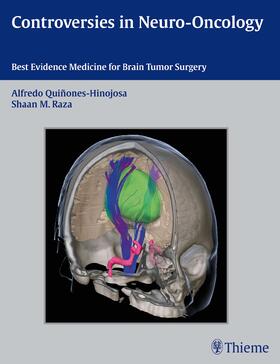 Quinones-Hinojosa / Raza |  Controversies in Neuro-Oncology | eBook | Sack Fachmedien