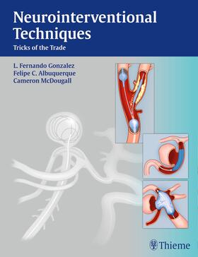 Gonzalez / Albuquerque / McDougall |  Neurointerventional Techniques | eBook | Sack Fachmedien