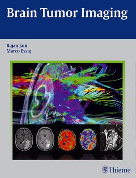 Jain / Essig |  Brain Tumor Imaging | Buch |  Sack Fachmedien