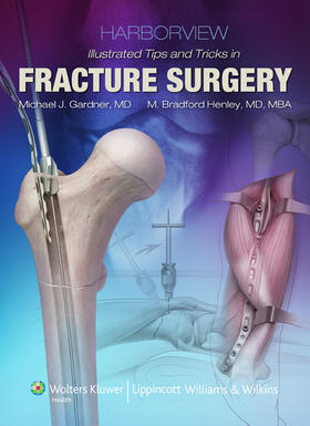 Gardner / Dunbar / Henley | Harborview Illustrated Tips and Tricks in Fracture Surgery | Buch | 978-1-60547-055-9 | sack.de