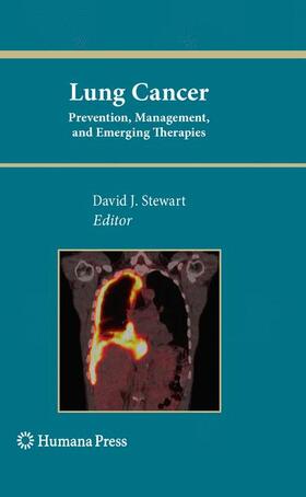 Stewart |  Lung Cancer: | Buch |  Sack Fachmedien
