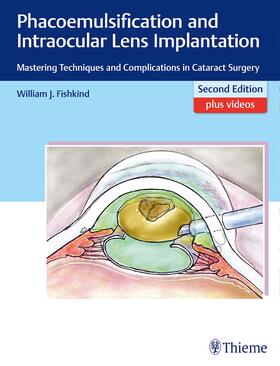 Fishkind |  Phacoemulsification and Intraocular Lens Implantation | Buch |  Sack Fachmedien