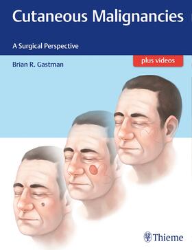 Gastman |  Cutaneous Malignancies | Buch |  Sack Fachmedien