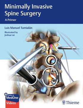 Tumialan |  Minimally Invasive Spine Surgery | eBook | Sack Fachmedien