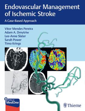 Pereira / Dmytriw / Slater |  Endovascular Management of Ischemic Stroke | Buch |  Sack Fachmedien