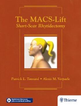Tonnard / Verpaele |  The MACS-Lift | eBook | Sack Fachmedien