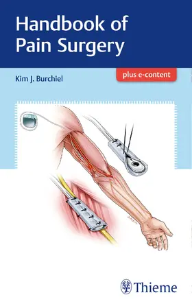 Burchiel |  Handbook of Pain Surgery | eBook | Sack Fachmedien