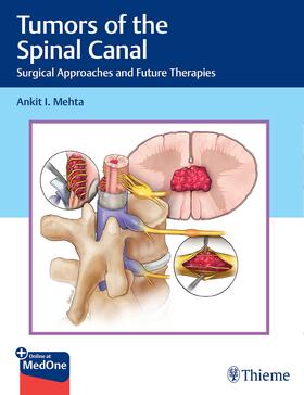 Mehta |  Tumors of the Spinal Canal | Buch |  Sack Fachmedien