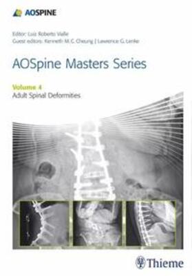 Lenke / Cheung |  AOSpine Masters Series, Volume 4: Adult Spinal Deformities | eBook | Sack Fachmedien