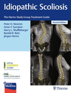 Newton / Samdani / Shufflebarger |  Idiopathic Scoliosis | eBook | Sack Fachmedien