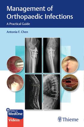 Chen |  Management of Orthopaedic Infections | eBook | Sack Fachmedien