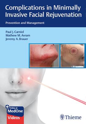 Carniol / Avram / Brauer |  Complications in Minimally Invasive Facial Rejuvenation | Buch |  Sack Fachmedien