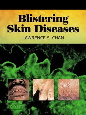 Chan |  Blistering Skin Diseases | Buch |  Sack Fachmedien