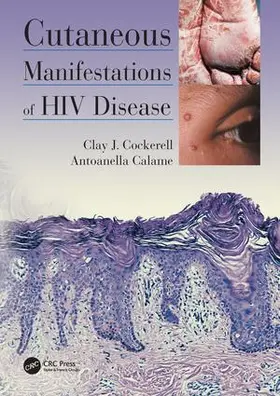 Cockerell / Calame |  Cutaneous Manifestations of HIV Disease | Buch |  Sack Fachmedien