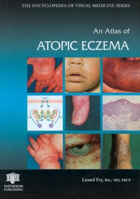 Fry |  An Atlas of Atopic Eczema | Buch |  Sack Fachmedien