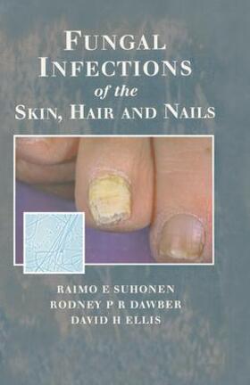 Suhonen / Dawber / Ellis |  Fungal Infections of the Skin and Nails | Buch |  Sack Fachmedien