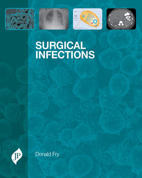 Fry |  Surgical Infections | Buch |  Sack Fachmedien