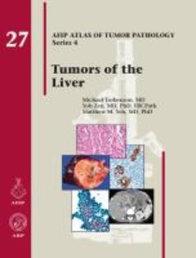 Torbenson |  Tumors of the Liver | Buch |  Sack Fachmedien