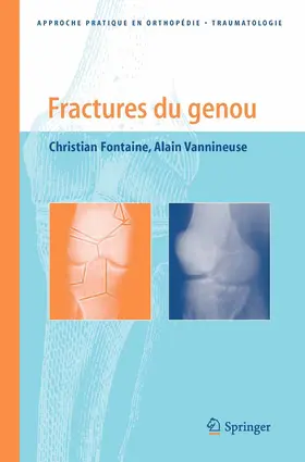 Fontaine / Vannineuse |  Fractures du genou | eBook | Sack Fachmedien