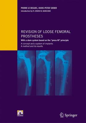 Le Béguec / Sieber |  Revision of Loose Femoral Prostheses with a Stem System Based on the "press-Fit" Principle | Buch |  Sack Fachmedien