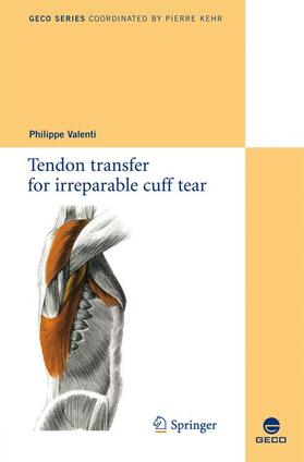 Valenti |  Tendon transfer for irreparable cuff tear | Buch |  Sack Fachmedien
