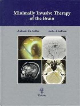 Antonio A.F. DeSalles |  Minimally Invasive Therapy of the Brain | Buch |  Sack Fachmedien