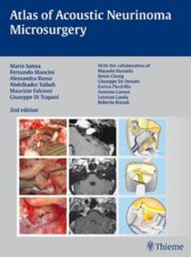Sanna / Mancini / Russo |  Atlas of Acoustic Neurinoma Microsurgery | Buch |  Sack Fachmedien
