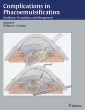 William J. Fishkind |  Complications in Phacoemulsification | Buch |  Sack Fachmedien