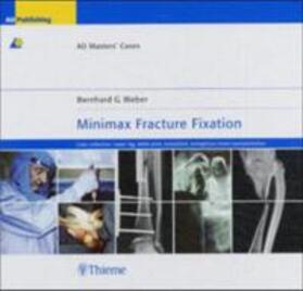 Weber |  Weber, B: Minimax Fracture Fixation | Buch |  Sack Fachmedien