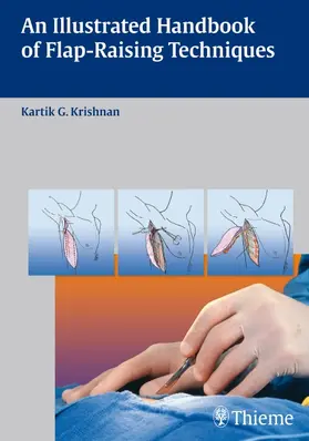 Krishnan |  An Illustrated Handbook of Flap-Raising Techniques | Buch |  Sack Fachmedien